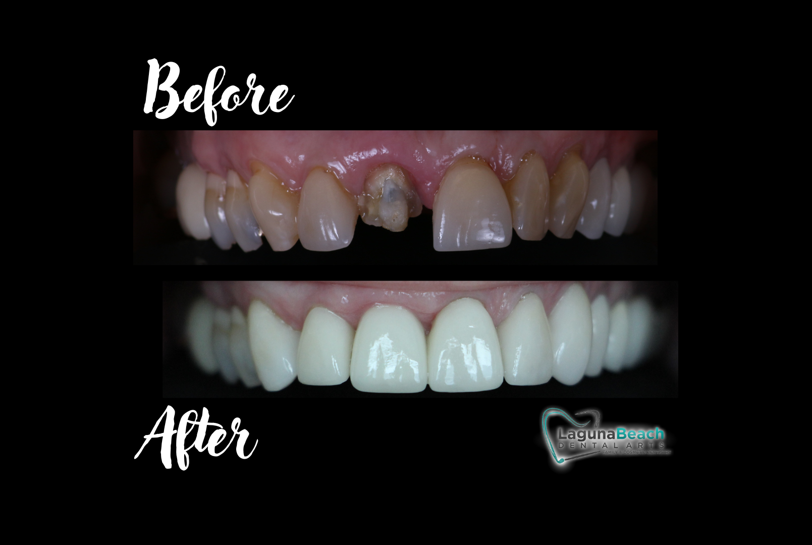 Before and after smile transformation with porcelain veneers